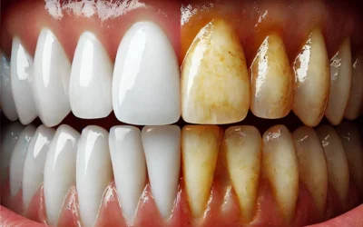 Say Goodbye to Teeth Tea Stains: Effective Ways to Prevent and Remove Stains from Teeth